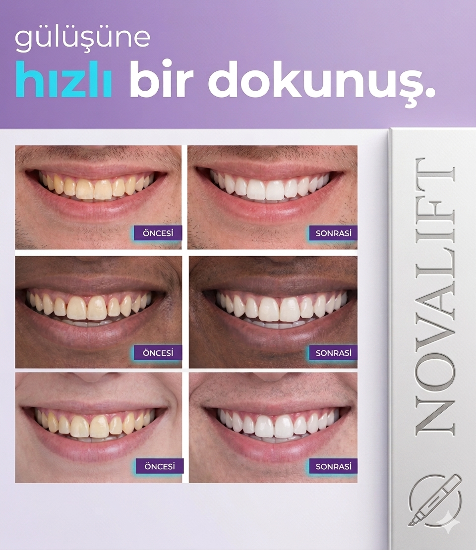 Profesyonel Diş Beyazlatma Bandı (Mor Etkili) – Evde Kolay Kullanım