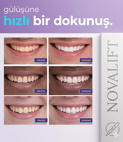 Novalift Premium Paketi 28x Şerit (Mor Diş Bandı)